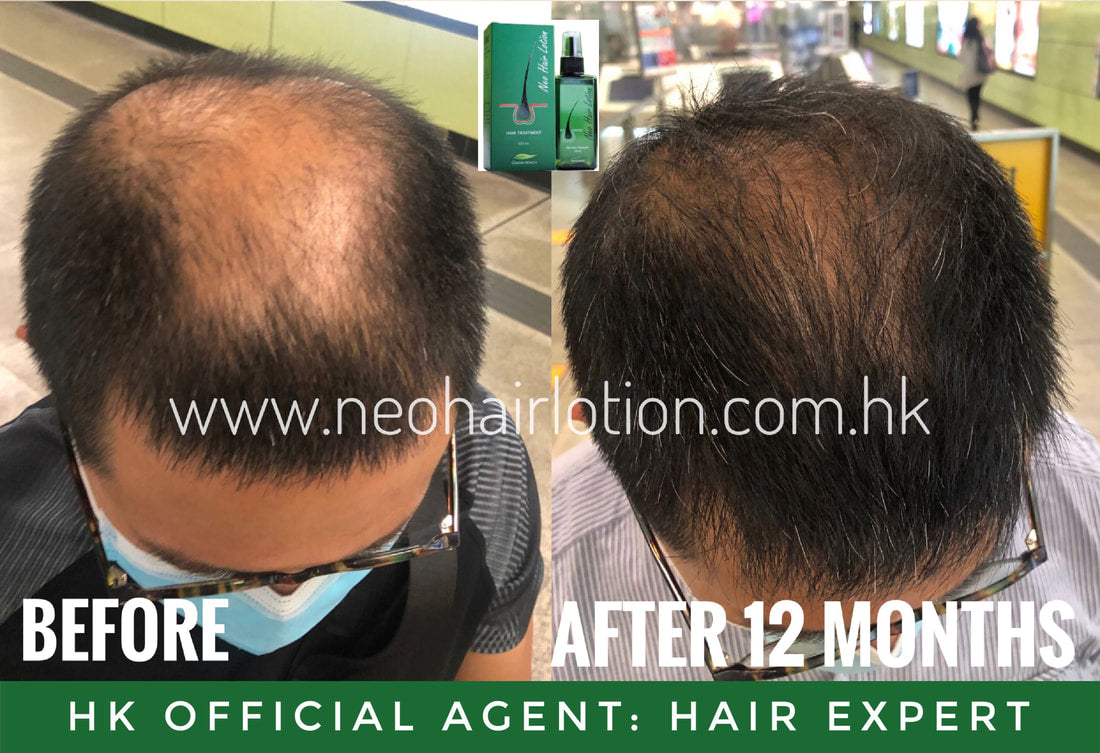 頭頂稀疏使用了Neo Hair Lotion 十二個月後的效果