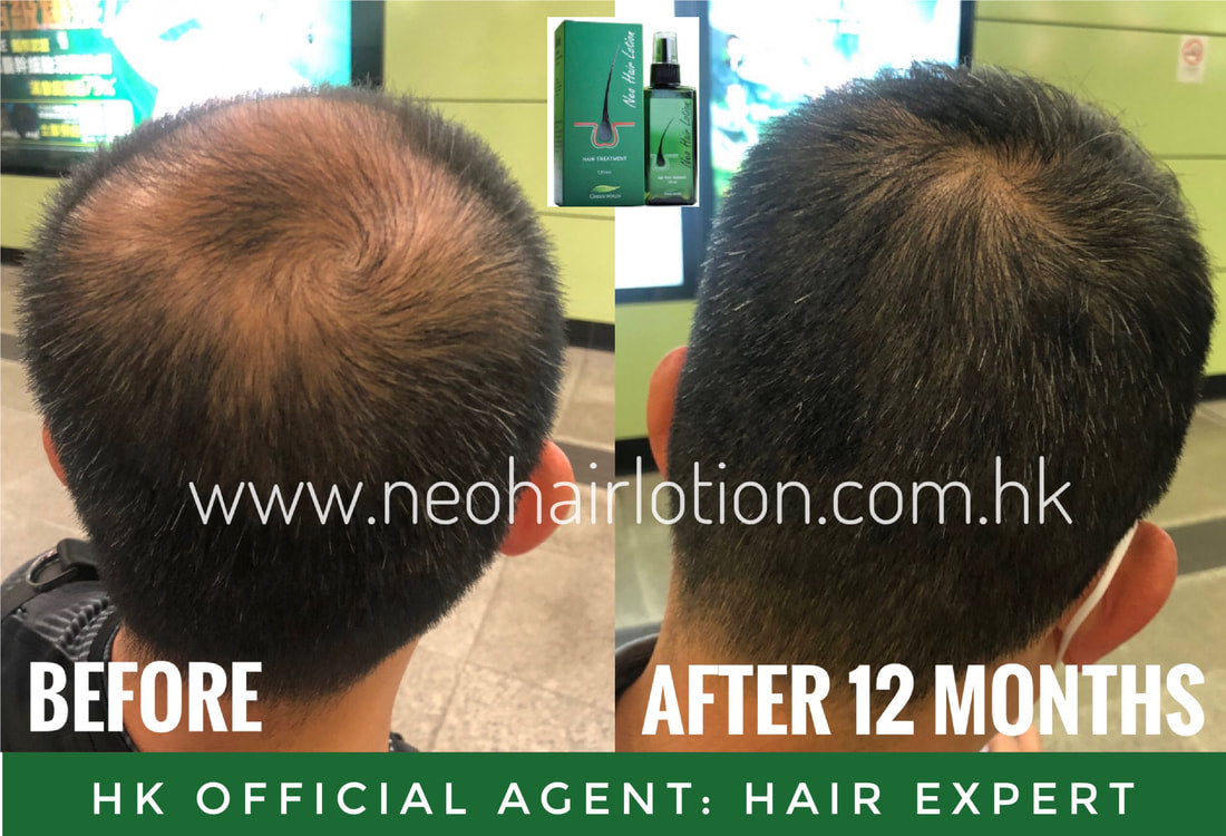 頭頂稀疏使用了Neo Hair Lotion 十二個月後的效果