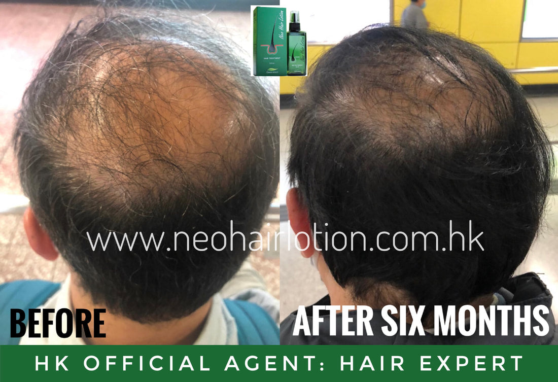 地中海使用了Neo Hair Lotion 六個月後的效果
