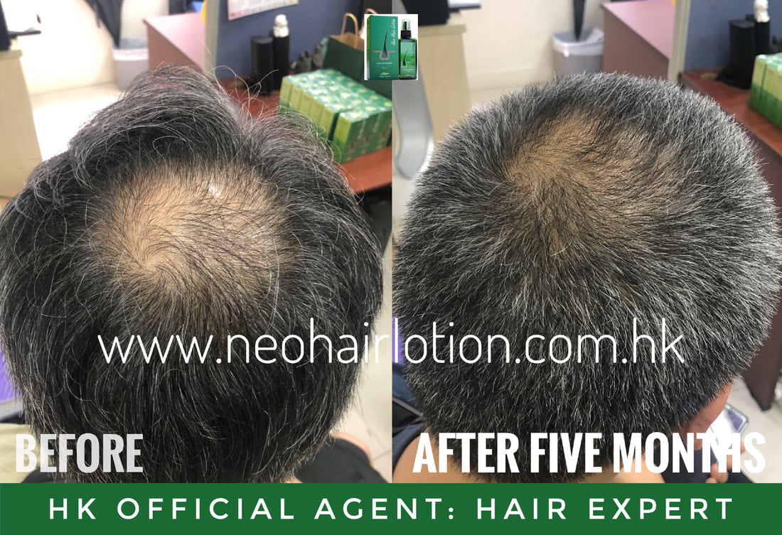 頭頂稀疏使用了Neo Hair Lotion 五個月後的效果