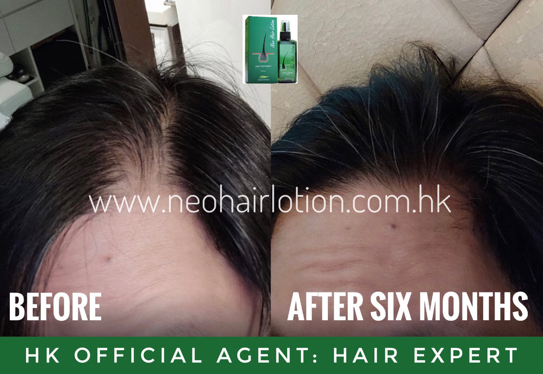 M字額使用了Neo Hair Lotion 六個月後的效果