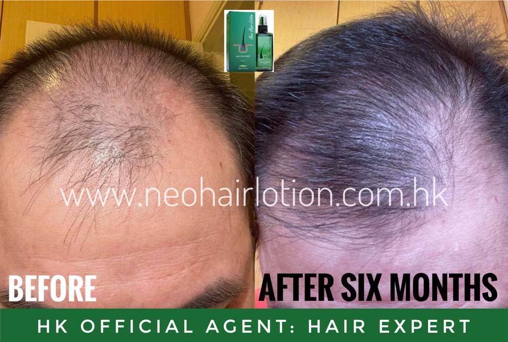 髮線後移使用了Neo Hair Lotion 六個月後的效果
