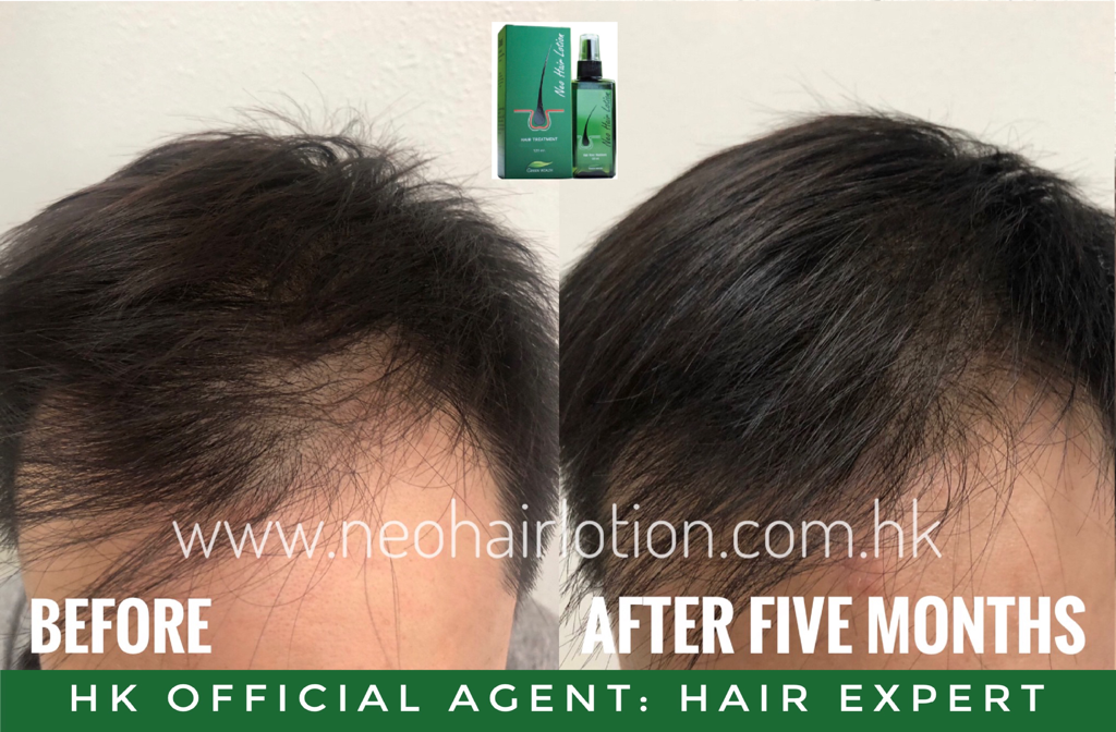 M字額使用了Neo Hair Lotion 五個月後的效果