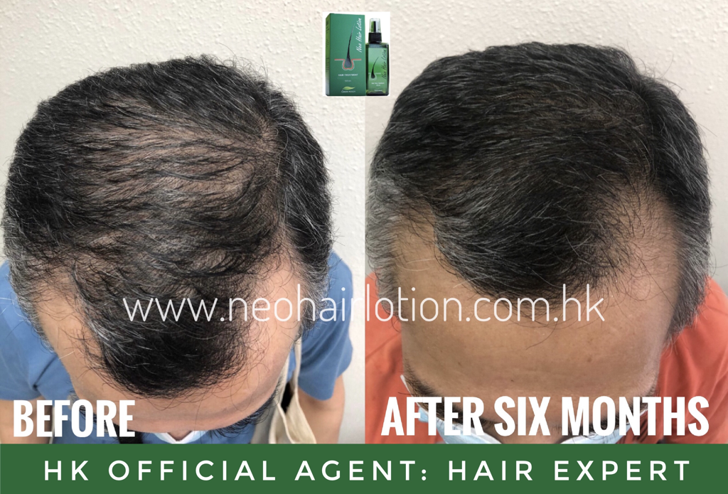 頭頂稀疏使用了Neo Hair Lotion 六個月後的效果
