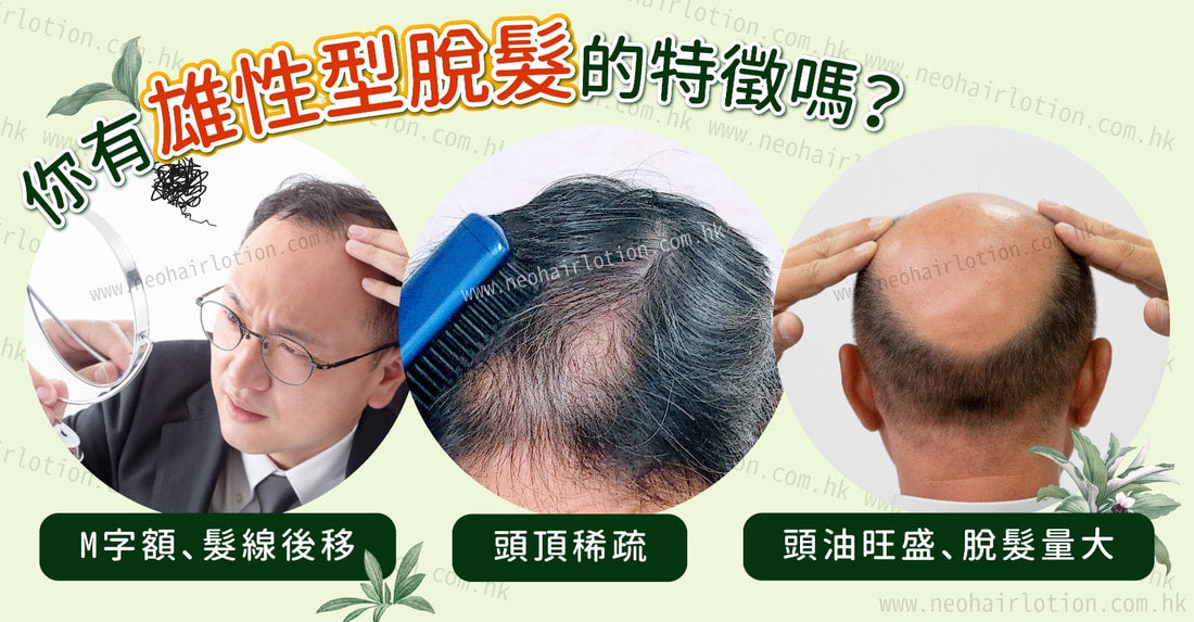 你有雄性型脫髮的特徵嗎?