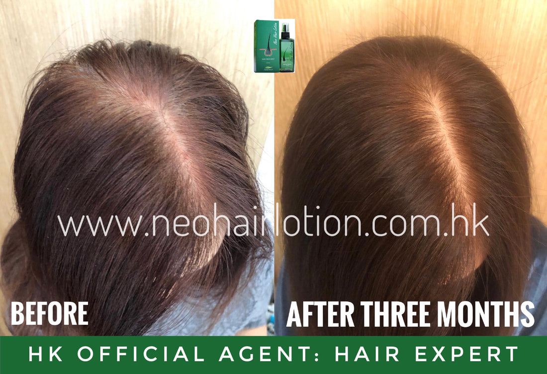 女士髮界稀疏使用了Neo Hair Lotion 三個月後的效果
