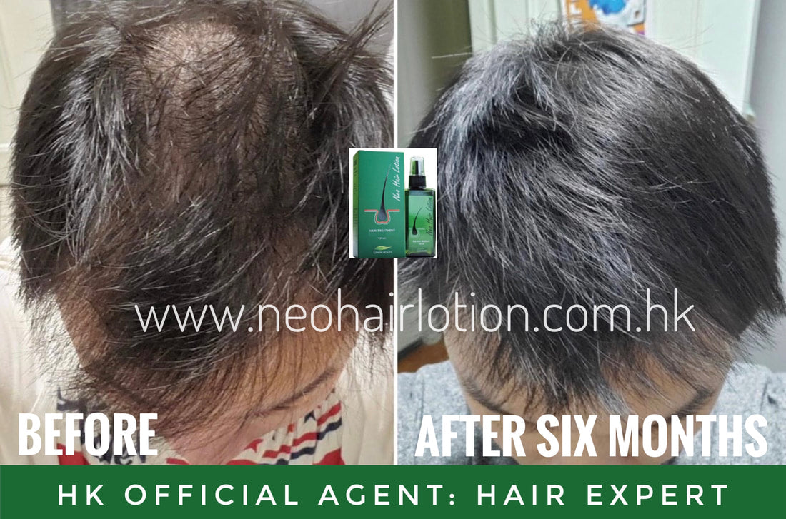頭頂稀疏使用了Neo Hair Lotion 六個月後的效果