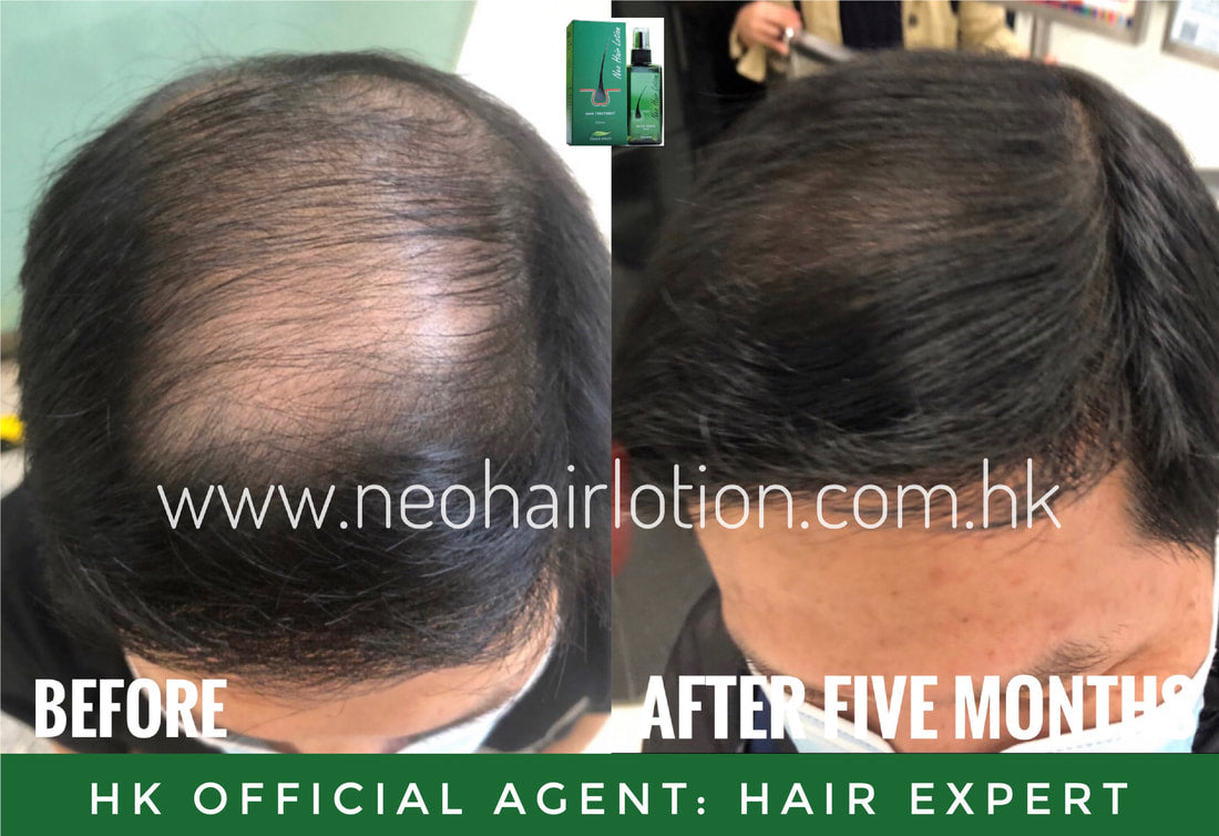 頭頂稀疏使用了Neo Hair Lotion 五個月後的效果