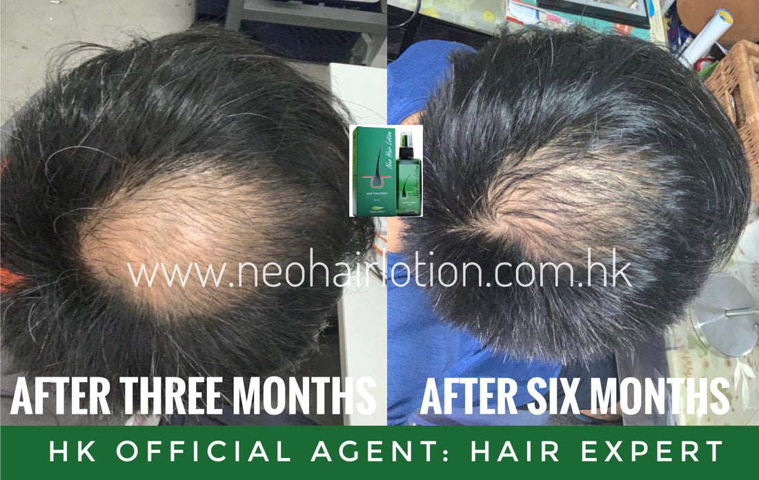 地中海使用了Neo Hair Lotion 六個月後的效果