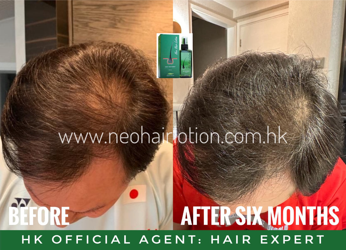 頭頂稀疏使用了Neo Hair Lotion 六個月後的效果