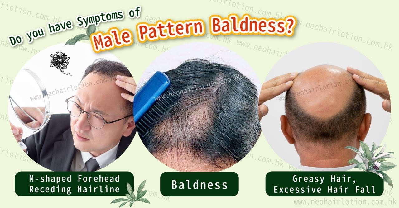 Do you have Symptoms of Male Pattern Baldness